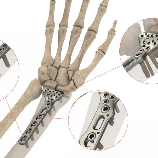 DISTAL RADIUS VOLAR PLATE