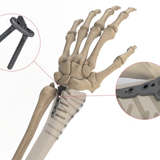 L SHAPE DISTAL RADIUS POSTERIOR PLATE