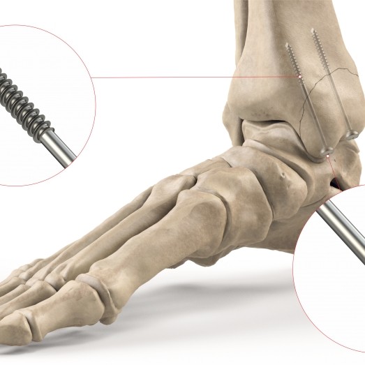 MALLEOLAR SCREW