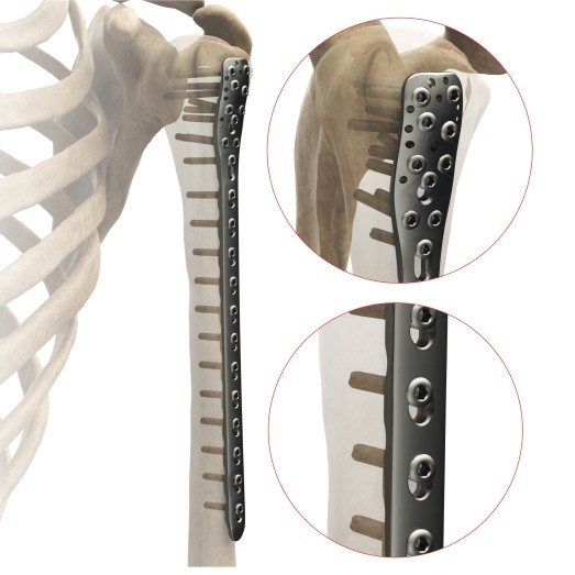 PROXIMAL HUMERUS PLATE