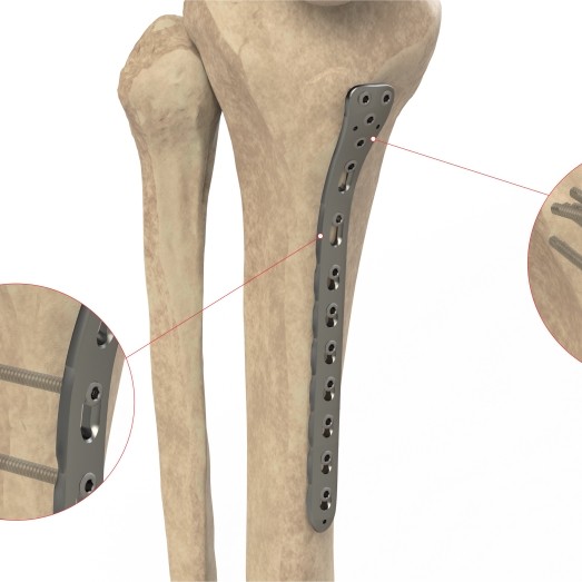 PROXIMAL TIBIA POSTERIOR LATERAL